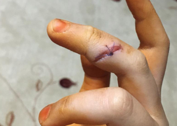 Özge sokak köpeklerinin saldırısında yaralandı