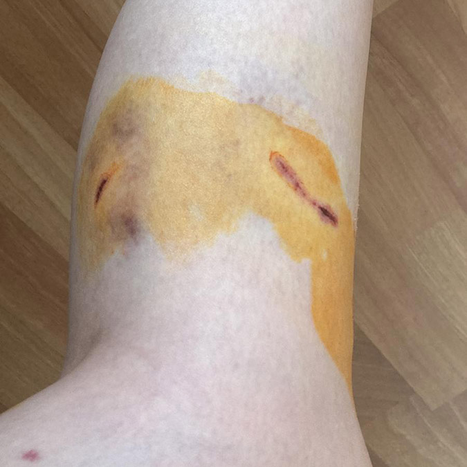 İzmit’te evinin önündeki durakta arkadaşını beklerken köpeklerin saldırısına uğrayan Duygu Yaren Dönmez (24) yaşananları anlattı.