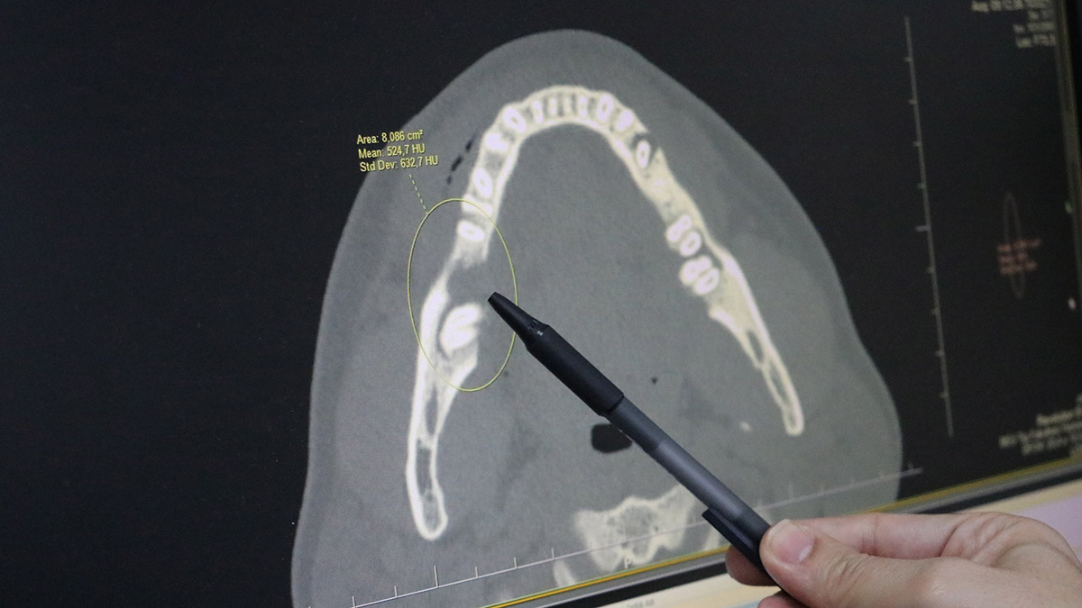 Çenesindeki tümör yerine bacağından kemik konuldu 