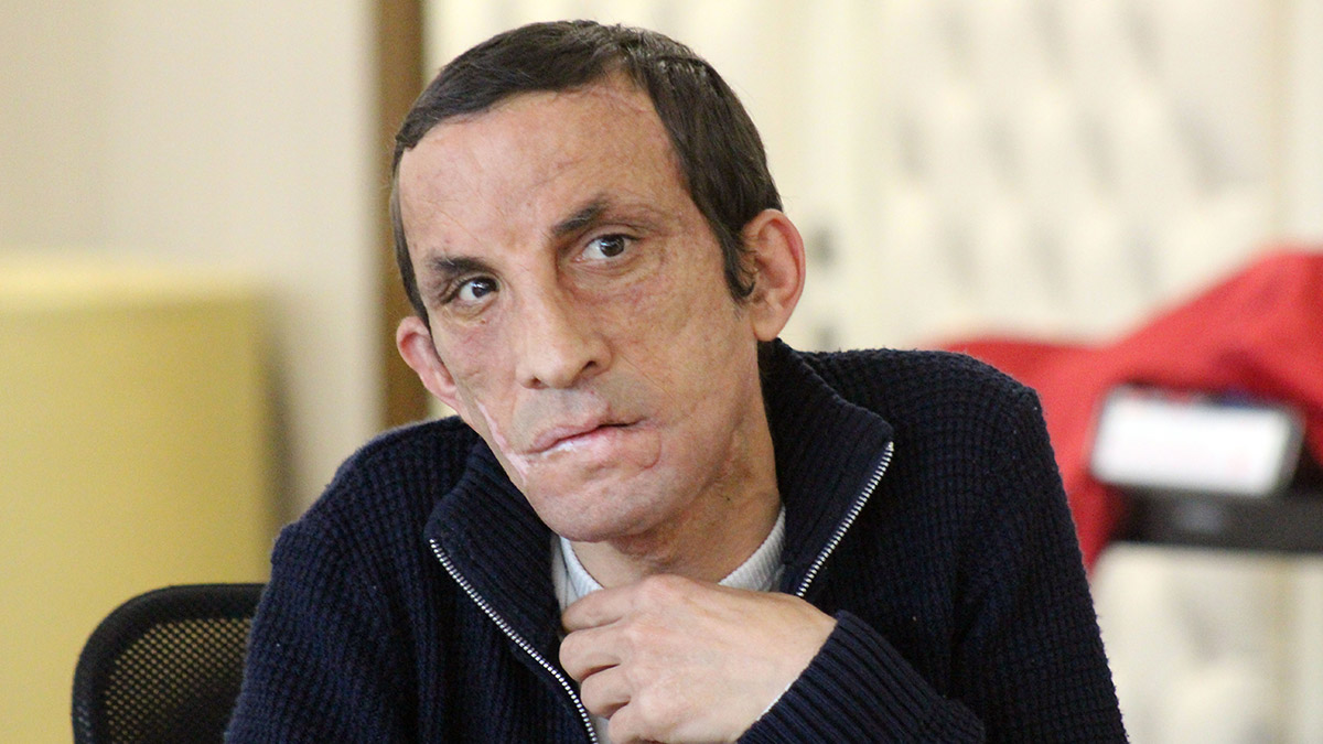 Türkiye'nin ilk yüz naklinin üzerinden 11 yıl geçti