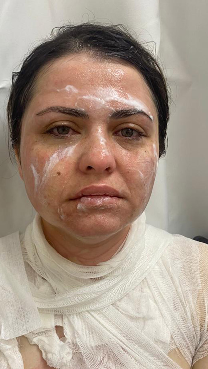 Eski eşinin kimyasal maddeli saldırısına uğradı