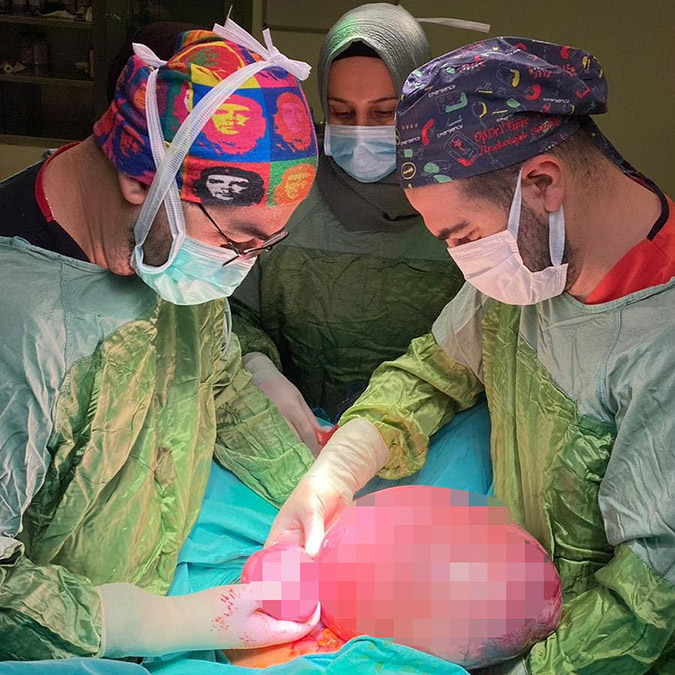 Karnından iki kitle çıkartıldı