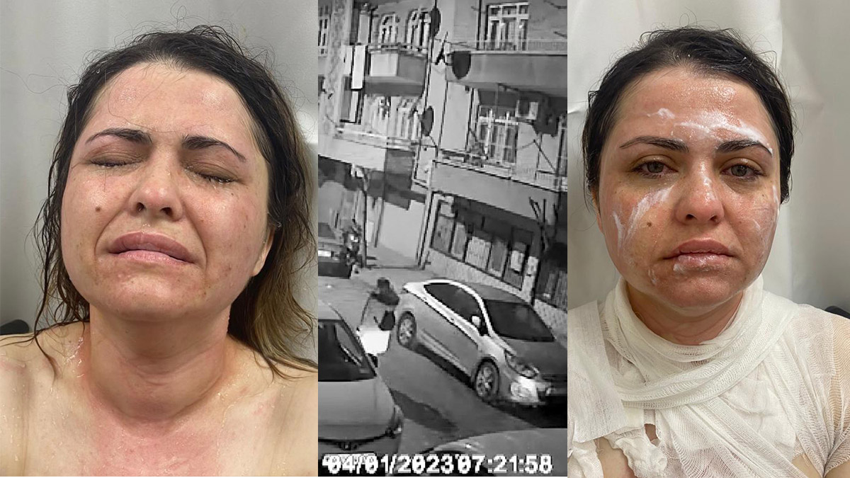 Eski eşinin kimyasal maddeli saldırısına uğradı