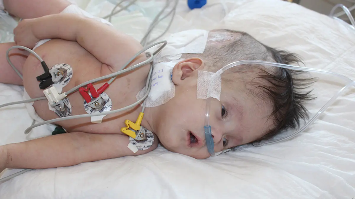 Hidrosefali hastasi depremzede bebek ameliyat edildig - yaşam - haberton