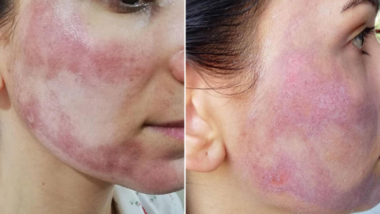 Cansu'nun yüzünü yakan güzellik merkezine ceza