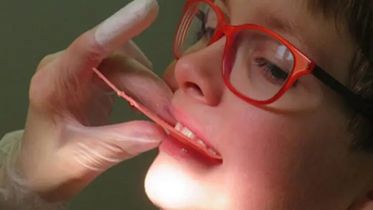 Çocuklarda çürüyen süt dişlerinin takibi yapılmalı