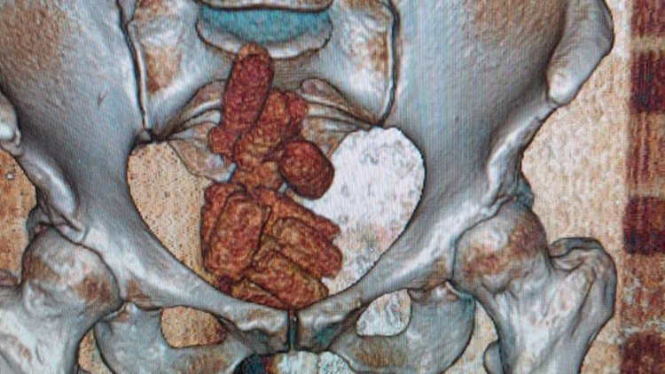Tomografi filminde bağırsaklarında uyuşturucu çıktı