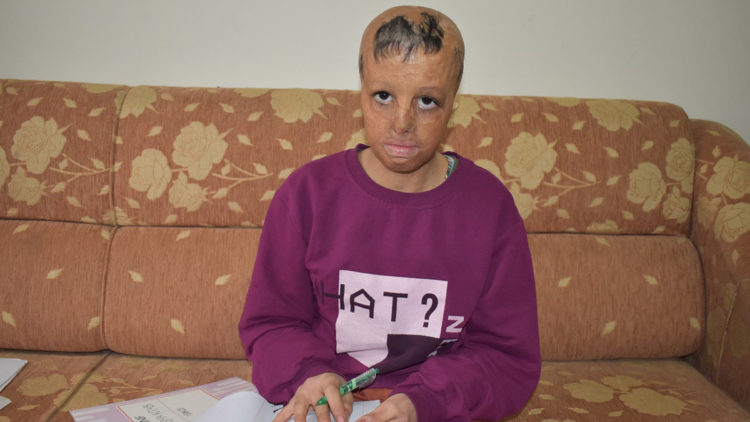 Suriye’nin Kamışlı bölgesinde bomba düşen evlerinde yüzü yanan Evin 10 yılda 109 ameliyat oldu.