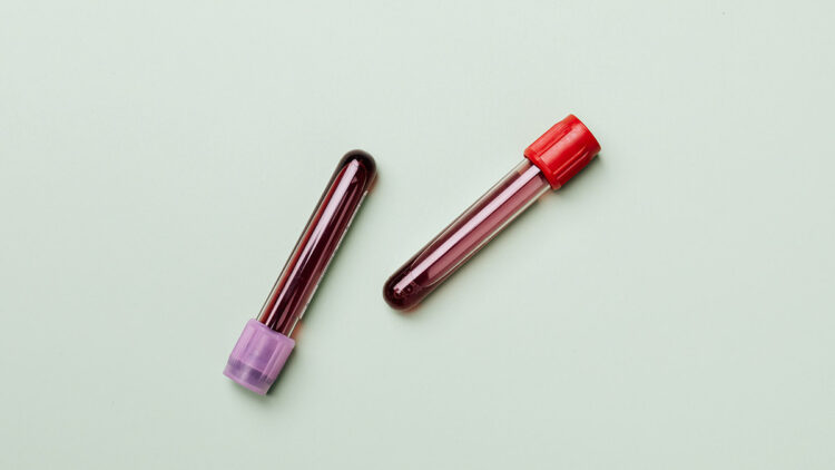 Akdeniz anemisinde demir birikmesi uyarısı