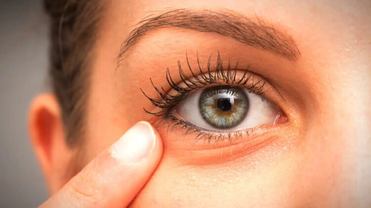Göz çevresi yaşlanması nasıl önlenebilir?