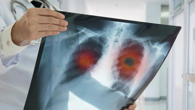 KOAH: Akciğer ve nefes