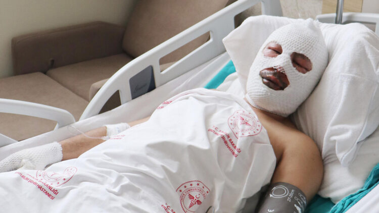 Zift tankındaki patlamada yaralanan işçi konuştu