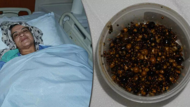 Safra kesesinden 2 bin taş çıkarıldı