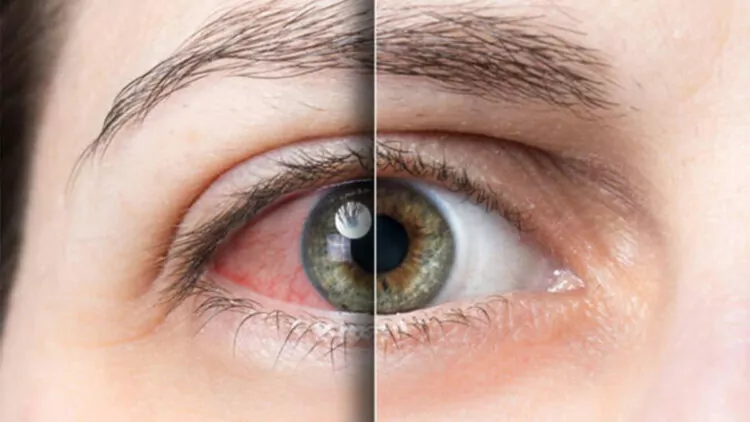 Göz alerjisi kornea ülserine neden olabilir