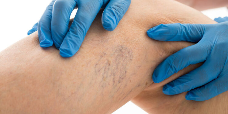 Evden çalışma, erken yaşta varis vakalarını artırıyor