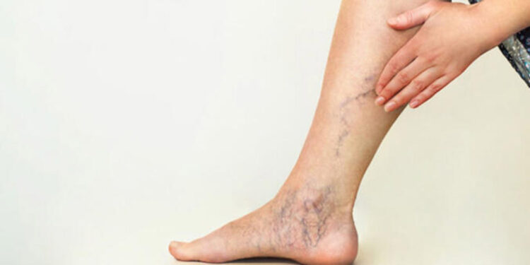 Hormonal değişiklikler varis oluşumunu etkileyebilir