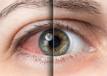 “mevsimsel alerjiler, en çok gözleri etkiliyor”