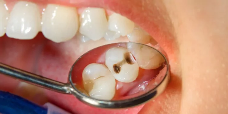 Okul çağındaki çocuklarda diş çürüğü sık görülüyor