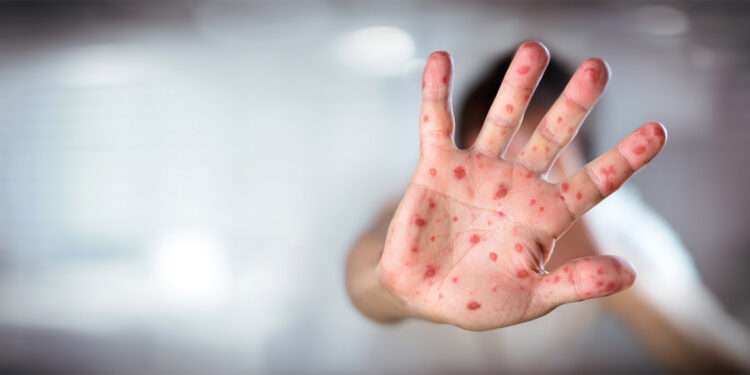 Kızamık vakalarında artışın sebebi aşı karşıtlığı