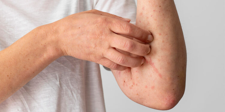 Kızamıktan korunmak için aşılama en etkili yöntem