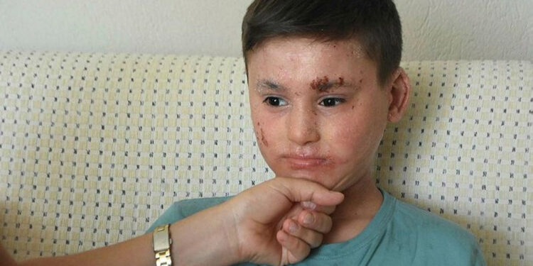 'Balık pulu' hastası Kayra, gündüzleri evden çıkamıyor