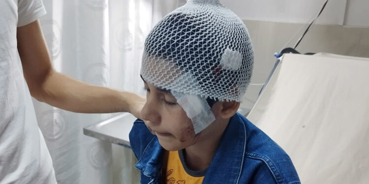 Salıncakta otururken yüzüne yorgun mermi isabet etti