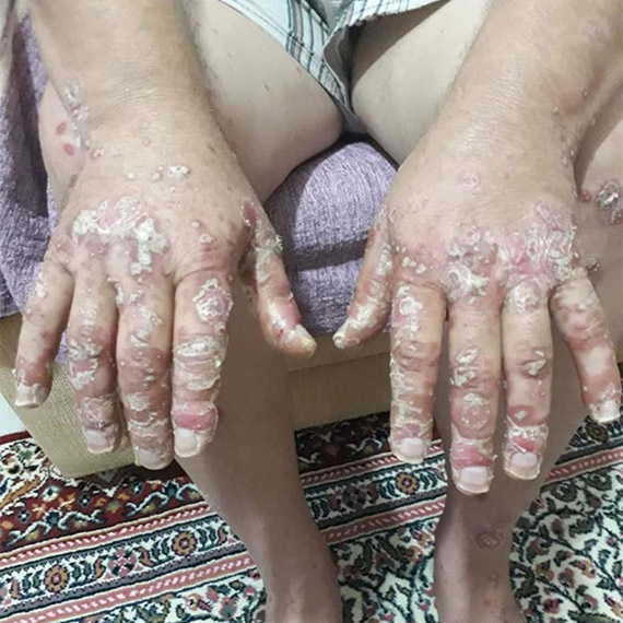 Antalya Eğitim ve Araştırma Hastanesi'nden Romatoloji Uzmanı Doç. Dr. Sibel Bakırcı, halk arasında omurga ya da bel romatizması olarak bilinen 'ankilozan spondilit' hastalığının erkeklerde 3 kat fazla görüldüğünü söyledi.