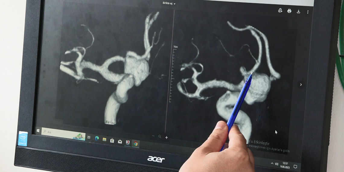 Doç. Dr. Murat Şakir Ekşi, "En büyük belirtisi şiddetli baş ağrısı olan beyin anevrizmalarında her zaman net, ayırıcı bir tanı olamayabilir" dedi.