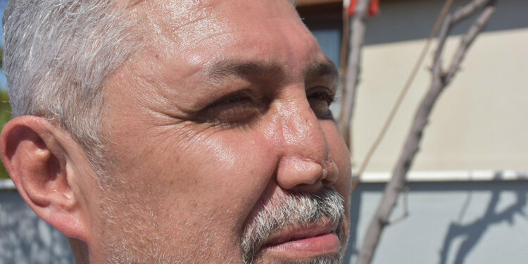 Burun estetiği ameliyatında doku kaybına tazminat davası