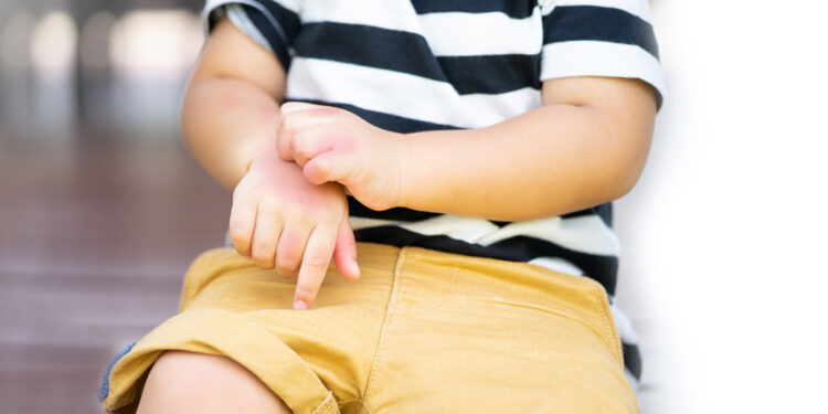 Egzama görülme sıklığı son 10 yılda arttı