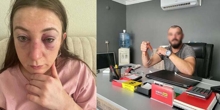 Eski sevgilisinin darbettiği Sibel: 9 defa yüzüme kafa attı