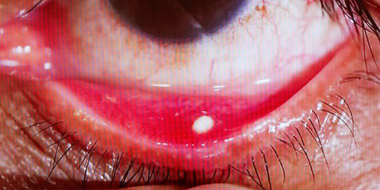 Gözünüzde batma varsa dikkat: göz taşınız olabilir