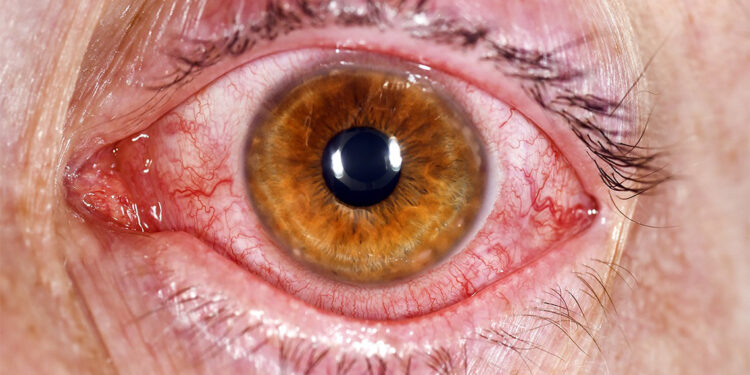 Pakistan'da 'kırmızı göz' salgını