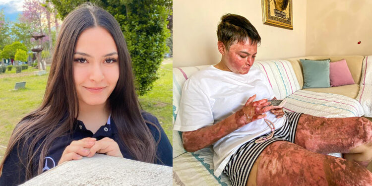 Benzin buharı parlayınca yüzü ve vücudu yandı