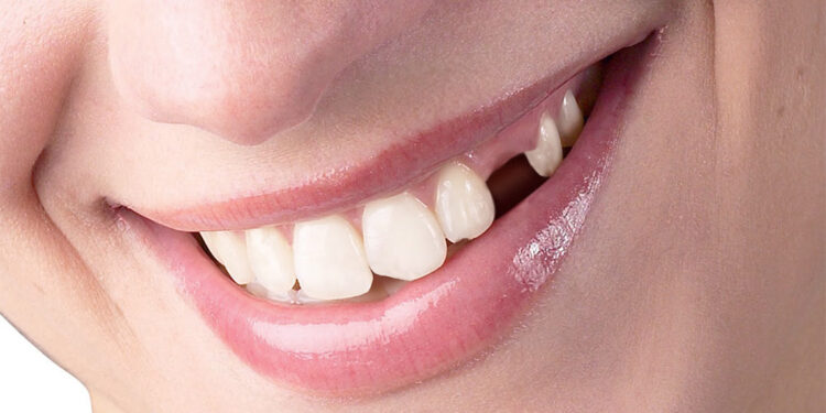 Eksik dişler nelere sebep olur