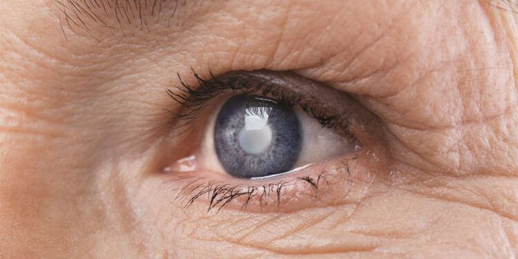 Katarakt her yaşta, hatta doğumla bile olabilir