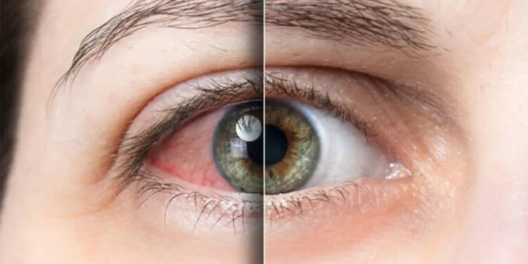 Artan viral enfeksiyonlar göz sağlığını da etkiledi