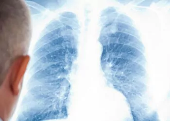 Akciğer kanseri dünyada en yaygın kanser türü