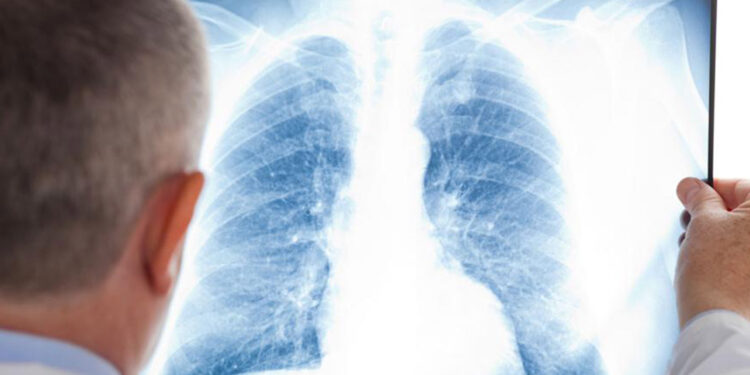 Akciğer kanseri dünyada en yaygın kanser türü