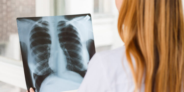 Her yıl 41 bin kişiye akciğer kanseri tanısı konuluyor