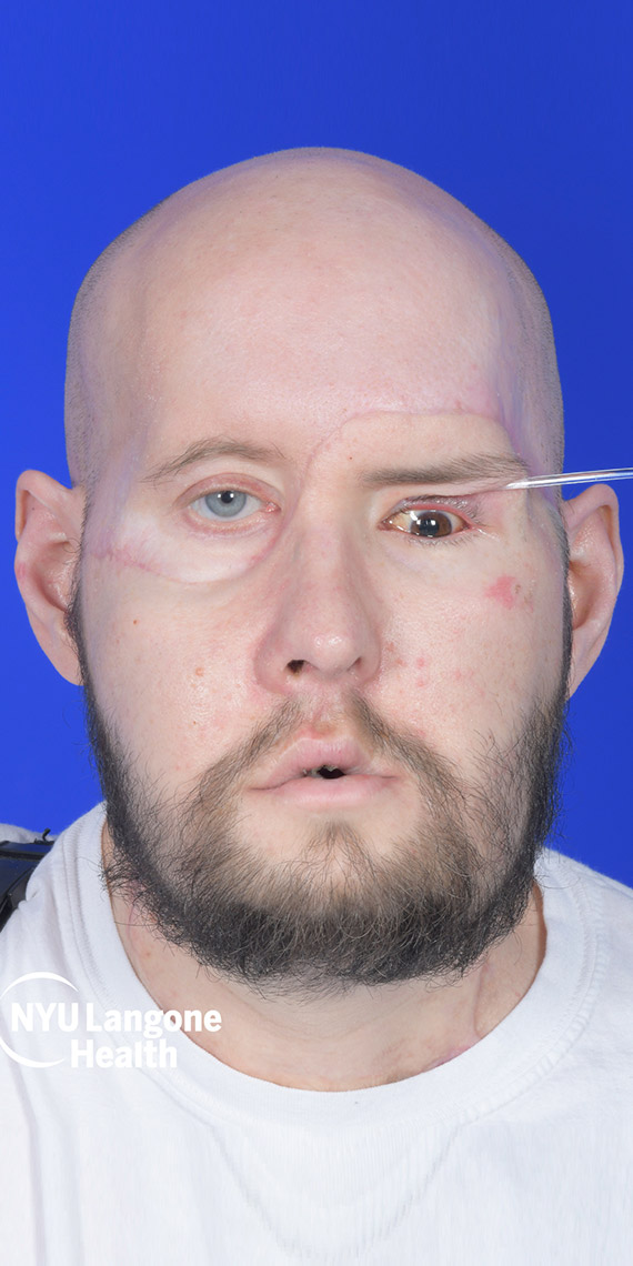 ABD'de bir hastaya ‘tam göz’ ve yarım yüz nakli yapıldı