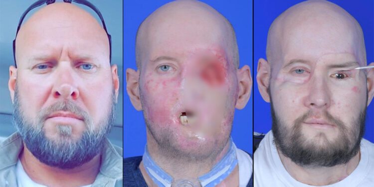 ABD'de bir hastaya ‘tam göz’ ve yarım yüz nakli yapıldı