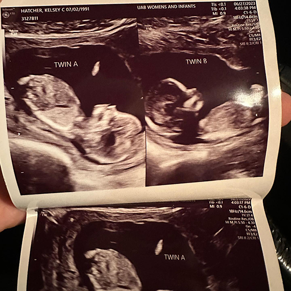 Çift rahimli kadın iki rahminde ayrı bebeklere hamile kaldı