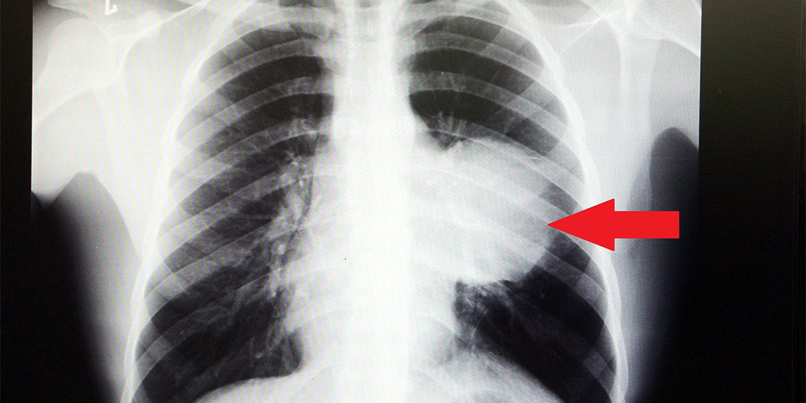 İstanbul'da yaşayan Burak Aktaş'ın (21) kalbini 12 santim sağa kaydıran 6.5 kiloluk dev tümör doktorlarını bile şaşırttı.