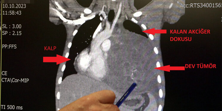 6.5 kiloluk dev tümör doktorları şaşırttı