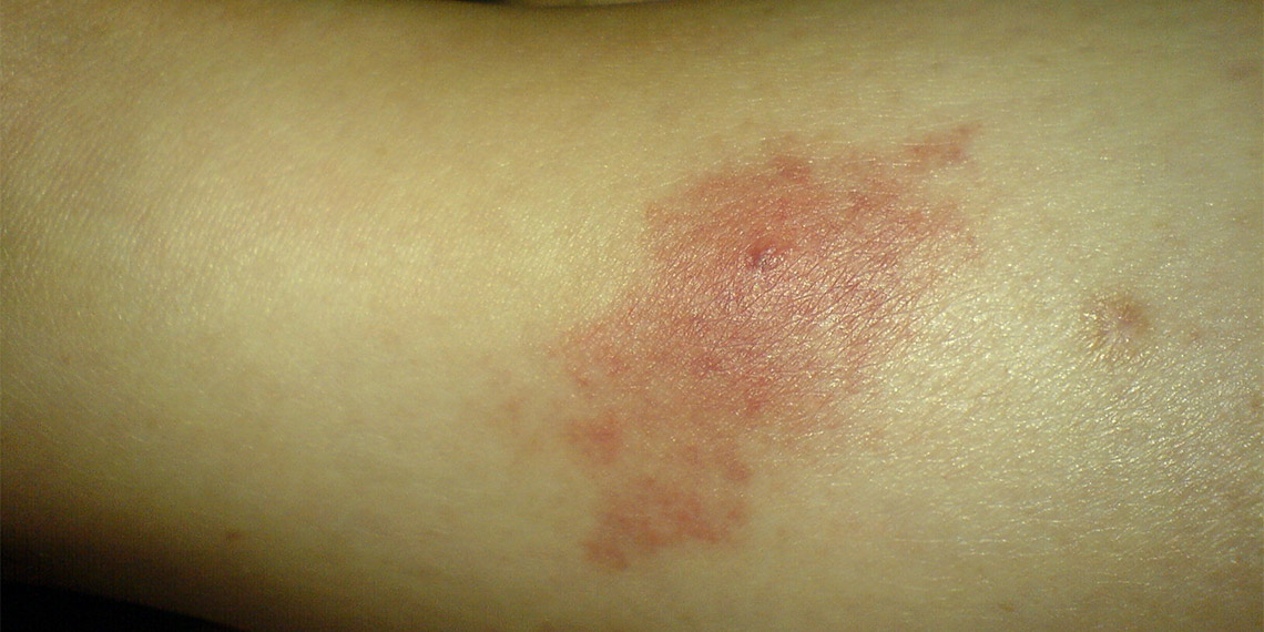 Çukurova Üniversitesi (ÇÜ) Halk Sağlığı Anabilim Dalı Öğretim Üyesi Prof. Dr. Ertan Kara, küresel ısınmayla birlikte sıcaklık artışı ve yüksek nem nedeniyle Türkiye'de bazı vektör türlerinin artışa geçtiğini ve uzun zamandır görülmeyen batı Nil ateşi, zika ve tatarcık humması gibi hastalıklar açısından dikkatli olunması gerektiğini söyledi.