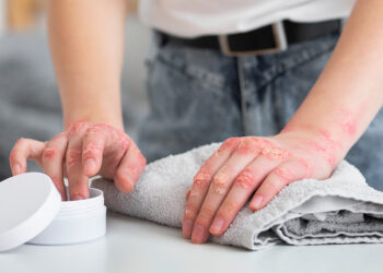 Sedef hastalığı hakkında gerçekler