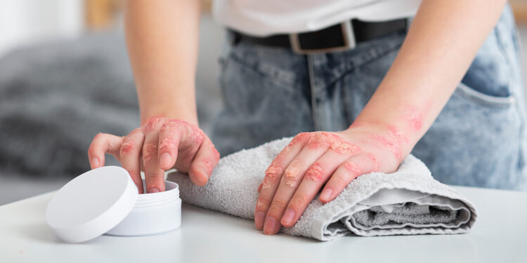 Sedef hastalığı hakkında gerçekler