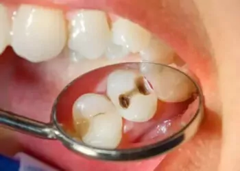 Çürük süt dişleri sürekli dişleri de çürütüyor