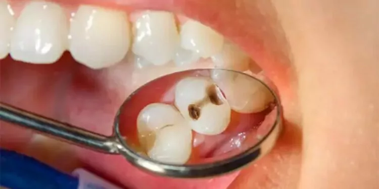 Çürük süt dişleri sürekli dişleri de çürütüyor